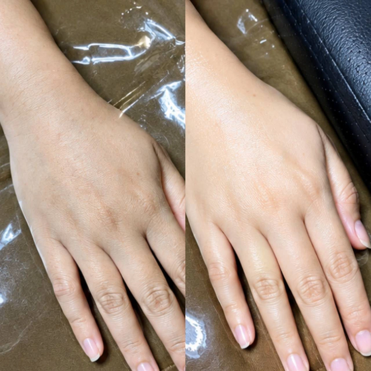 SkinzCantik hand treatment comparison